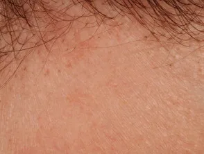 Alopecia areata