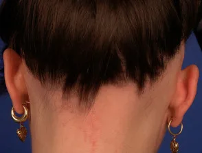 Alopecia areata