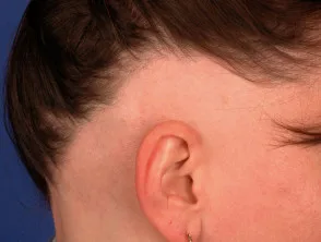 Alopecia areata