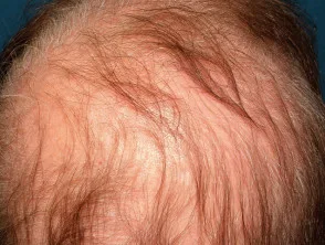 Alopecia areata