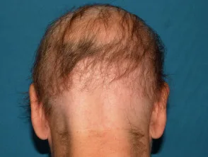 Alopecia areata