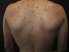 Immagini di acne che colpisce la schiena