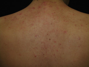 Imágenes de acné que afecta la espalda