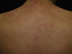 Immagini di acne che colpisce la schiena