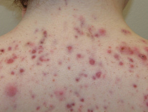 Imágenes de acné que afecta la espalda