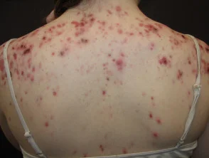 Immagini di acne che colpisce la schiena