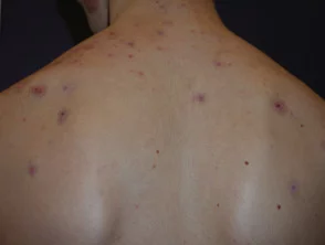 Immagini di acne che colpisce la schiena