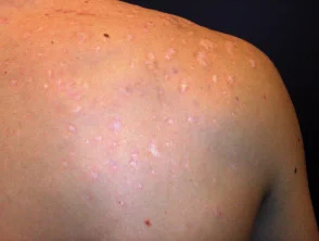 Immagini di acne che colpisce la schiena