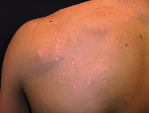 Immagini di acne che colpisce la schiena