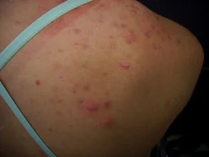 Immagini di acne che colpisce la schiena