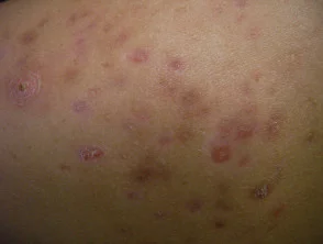 Immagini di acne che colpisce la schiena