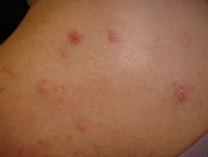 Immagini di acne che colpisce la schiena