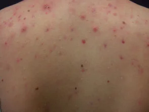 Immagini di acne che colpisce la schiena