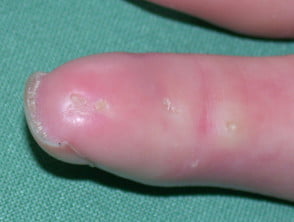 Calcinosis cutis