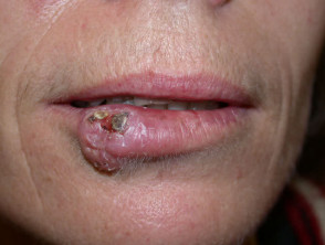 Carcinoma de células escamosas de labio