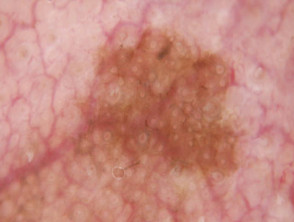 Círculos concéntricos grises observados en la dermatoscopia de lentigo maligno