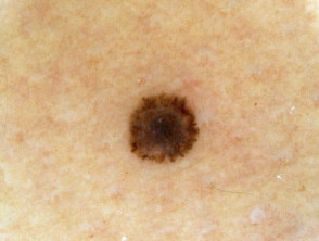 Dermatoscopia de reed nevus que muestra un patrón de estallido estelar