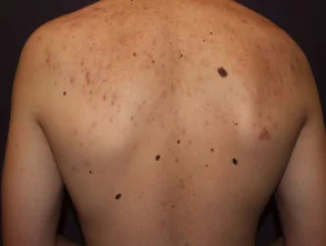 Immagini di acne che colpisce la schiena