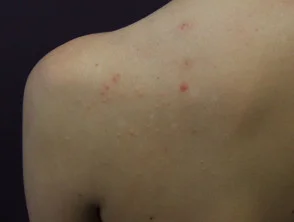 Immagini di acne che colpisce la schiena