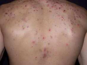 Immagini di acne che colpisce la schiena