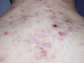 Immagini di acne che colpisce la schiena