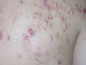 Immagini di acne che colpisce la schiena