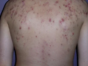 Immagini di acne che colpisce la schiena