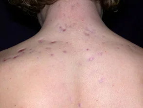 Immagini di acne che colpisce la schiena