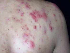 Immagini di acne che colpisce la schiena