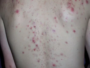 Immagini di acne che colpisce la schiena