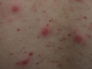 Immagini di acne che colpisce la schiena