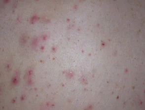 Immagini di acne che colpisce la schiena