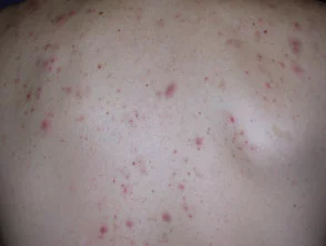 Immagini di acne che colpisce la schiena