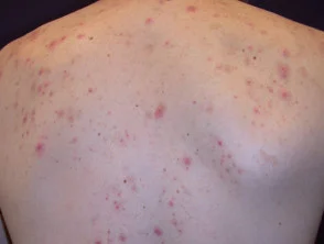 Immagini di acne che colpisce la schiena