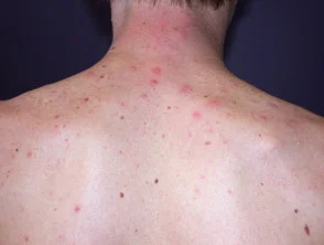 Immagini di acne che colpisce la schiena