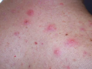 Immagini di acne che colpisce la schiena