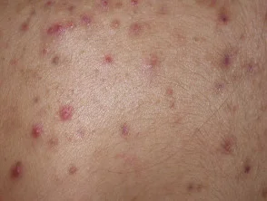 Immagini di acne che colpisce la schiena