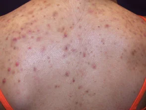 Immagini di acne che colpisce la schiena