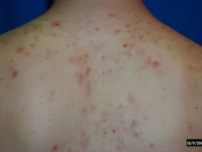 Immagini di acne che colpisce la schiena