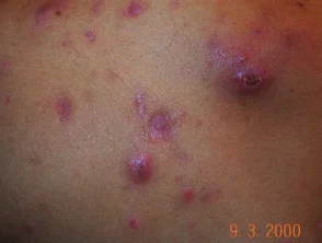 Immagini di acne che colpisce la schiena