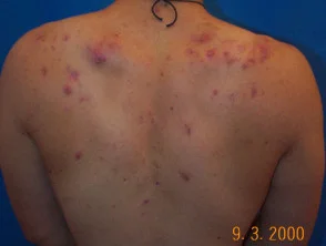 Immagini di acne che colpisce la schiena