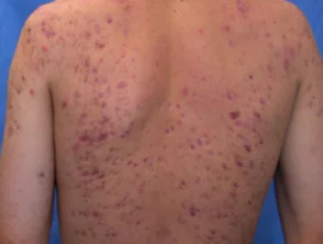 Immagini di acne che colpisce la schiena