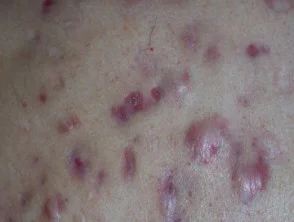 Immagini di acne che colpisce la schiena