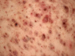 Immagini di acne che colpisce la schiena