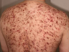 Immagini di acne che colpisce la schiena