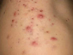 Immagini di acne che colpisce la schiena