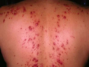 Immagini di acne che colpisce la schiena