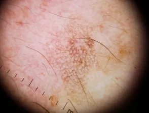 Patrón granular anular visto en dermatoscopia de queratosis similar a liquen plano