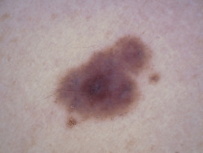 Nevus, dermatoscopia de piel tipo 4 4