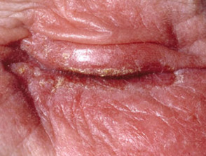 Dermatitis alérgica de contacto en el párpado.